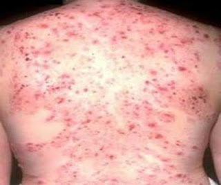 Gambar Herpes Zoster - Yang Dapat Anda Harapkan Saat Terserang Herpes zoster mungkin ingin mengunjungi dokter untuk
